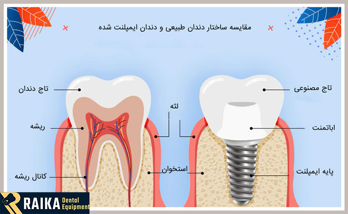 ساختار ایمپلنت دندان