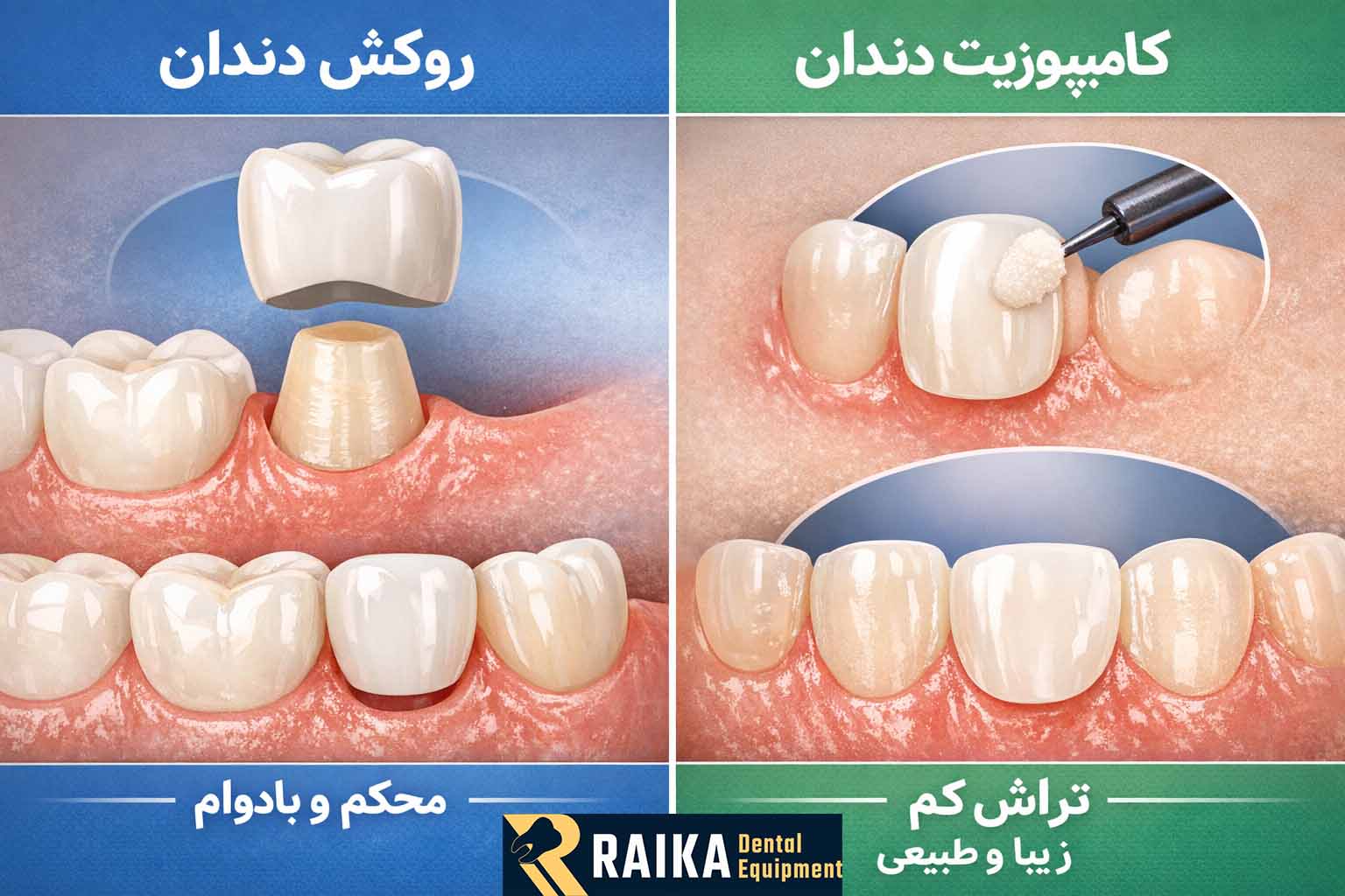 تفاوت شیوه انجام روکش دندان با کامپوزیت دندان