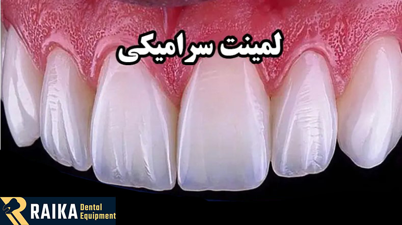 روکش دندان بهتر است یا کامپوزیت؟