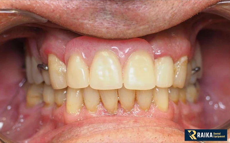 بهترین جایگزین دندان از دست رفته چیست؟