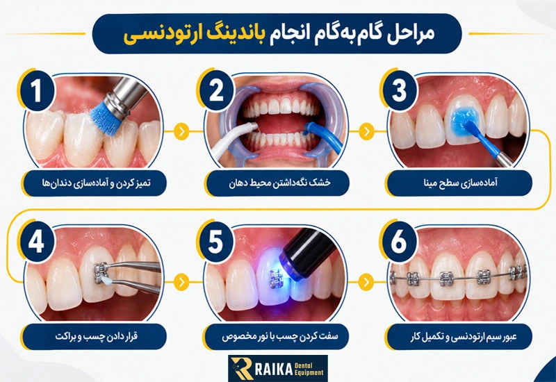 اینفوگرافیک مراحل گام به گام انجام باندینگ ارتودنسی